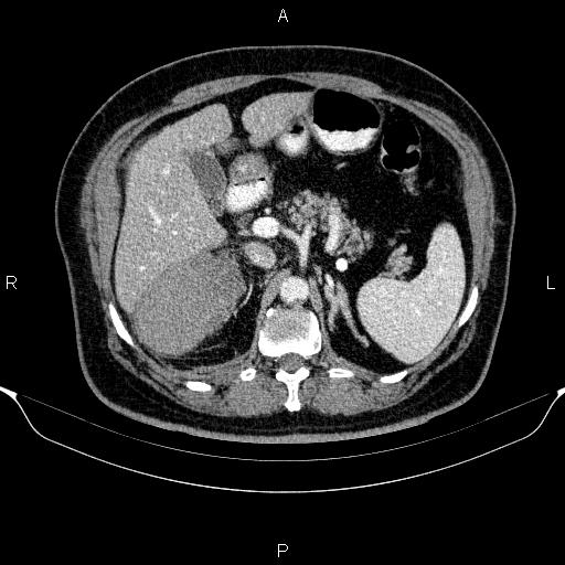 Adrenal hemorrhage (Radiopaedia 62622-70916 Axial C+ portal venous phase 57).jpg