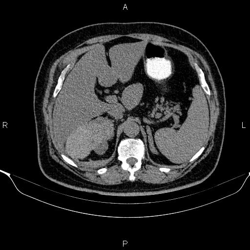 Adrenal hemorrhage (Radiopaedia 62622-70916 Axial non-contrast 48).jpg