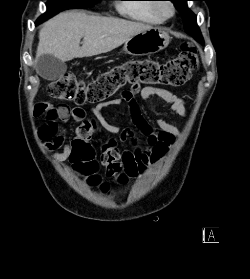 Adrenal lymphoma (Radiopaedia 73730-84529 Coronal C+ portal venous phase 16).jpg