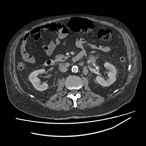 Adrenal lymphoma (Radiopaedia 84145-99415 Axial C+ portal venous phase 60).jpg