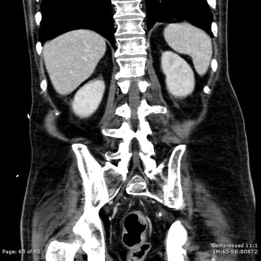 File:Adrenal metastasis (Radiopaedia 78425-91079 Sagittal C+ portal venous phase 52).jpg