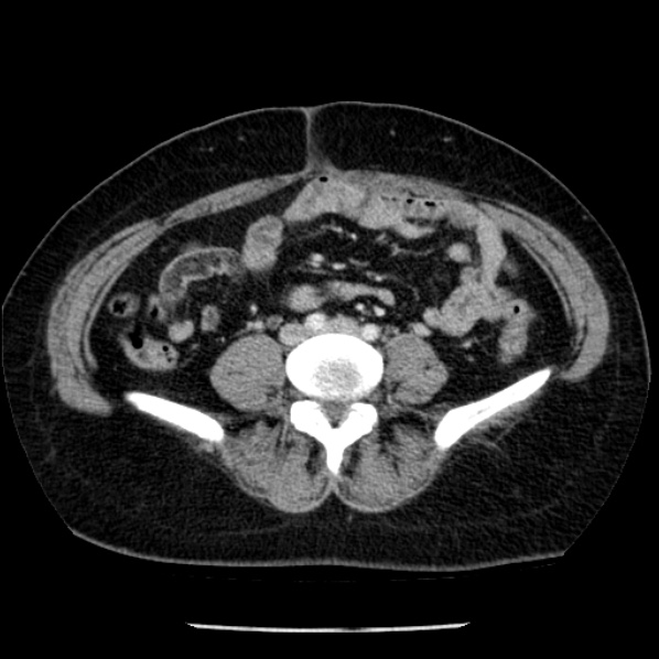 Adrenal myelolipoma (Radiopaedia 43401-46759 Axial C+ portal venous phase 55).jpg