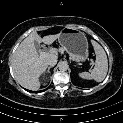 Adrenal myelolipoma (Radiopaedia 82742-96986 Axial renal excretory phase 32).jpg
