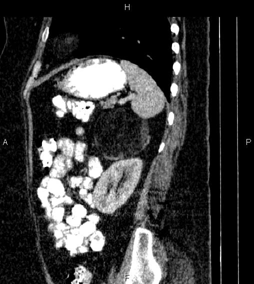 Adrenal myelolipoma (Radiopaedia 84319-99617 Sagittal renal cortical phase 73).jpg