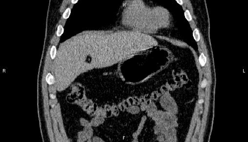 Adrenal myelolipoma (Radiopaedia 84321-99619 Coronal non-contrast 14).jpg