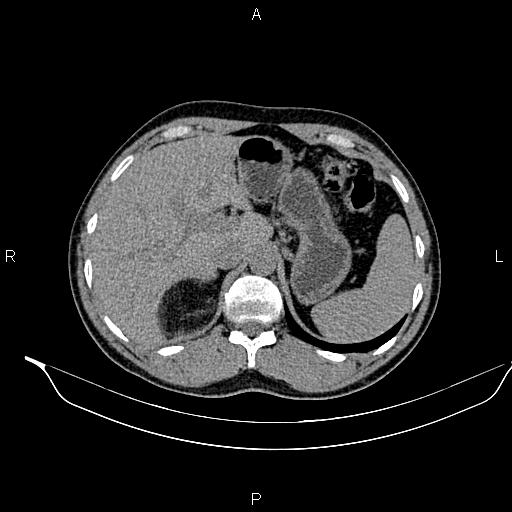Adrenal myelolipoma (Radiopaedia 87794-104246 Axial non-contrast 26).jpg