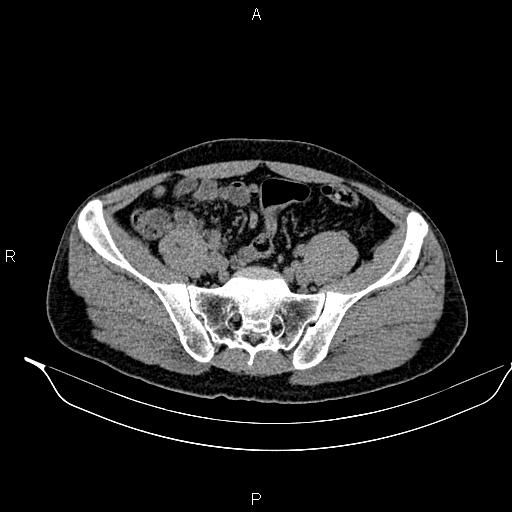 File:Adrenal myelolipoma (Radiopaedia 87794-104246 Axial non-contrast 81).jpg