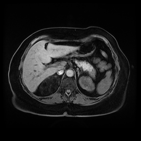 Adrenal myelolipoma - MRI (Radiopaedia 83249-97646 Axial T1 fat sat 26).jpg
