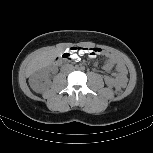 Adrenal myelolipoma - bilateral (Radiopaedia 74805-85810 Axial non-contrast 42).jpg