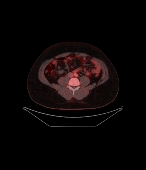 Adrenocortical carcinoma (Radiopaedia 80134-93440 ِAxial 201).jpg