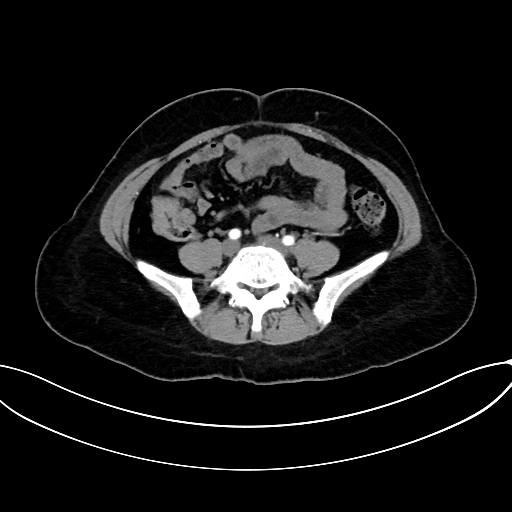 Adrenocortical carcinoma (Radiopaedia 87281-103569 Axial C+ arterial phase 59).jpg