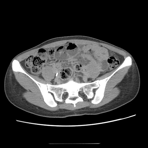 Adult polycystic kidney disease (Radiopaedia 48845-53876 Axial renal excretory phase 69).jpg