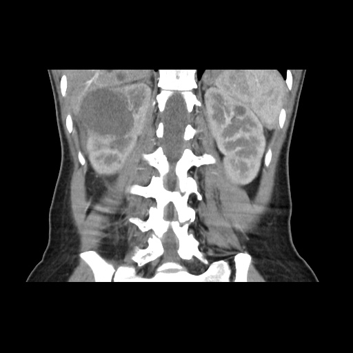 File:Adult polycystic kidney disease (Radiopaedia 48845-53876 Coronal renal cortical phase 28).jpg
