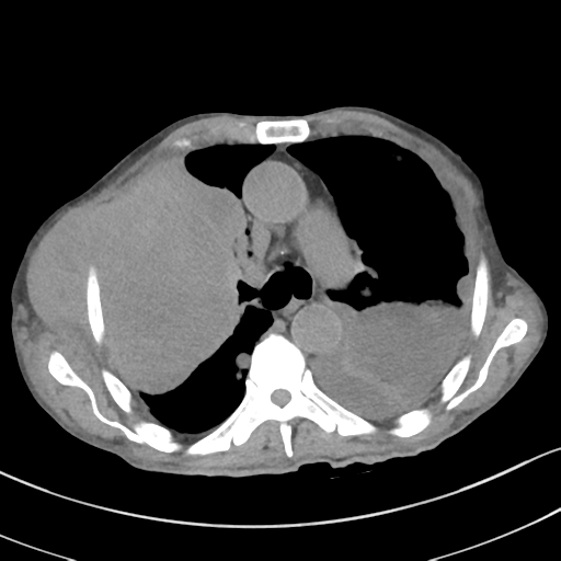 Advanced metastatic lung cancer (Radiopaedia 48910-53954 Axial non-contrast 27).png