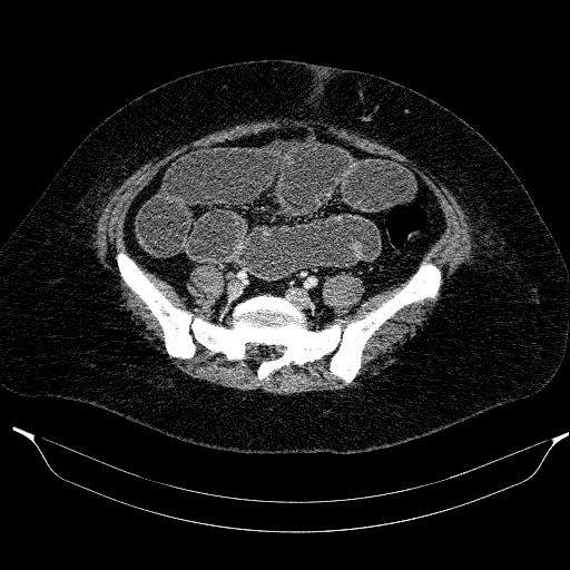 File:Afferent loop syndrome - secondary to incarcerated trocar site hernia (Radiopaedia 82959-97305 Axial C+ portal venous phase 169).jpg