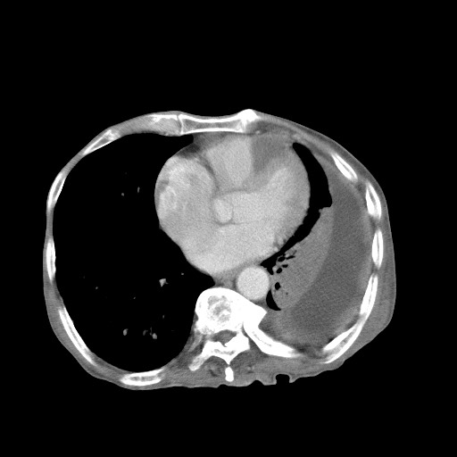 File:Aggressive lung cancer with cardiac metastases, pulmonary artery tumor thrombus, and Budd-Chiari (Radiopaedia 60320-67981 A 38).jpg
