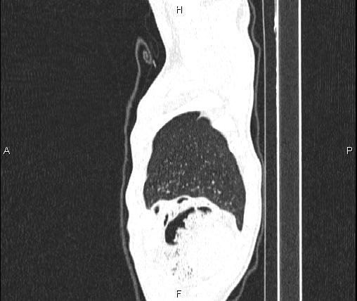Air bronchogram in pneumonia (Radiopaedia 85719-101512 Sagittal lung window 96).jpg