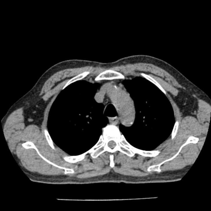 Airway foreign body in adult (Radiopaedia 85907-101779 Axial liver window 31).jpg