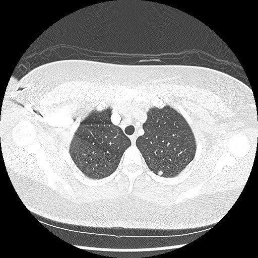 Alveolar soft part sarcoma - right leg (Radiopaedia 59432-67091 Axial lung window 23).jpg
