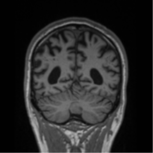 Alzheimer's disease- with Gerstmann syndrome and dressing apraxia (Radiopaedia 54882-61150 Coronal T1 24).png