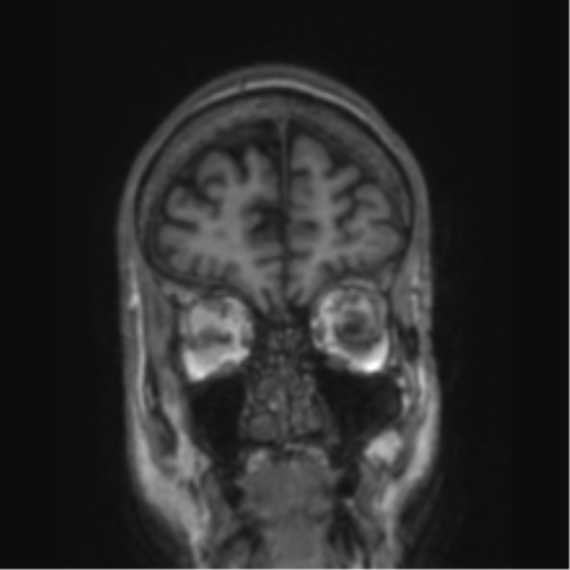 File:Alzheimer's disease- with apraxia (Radiopaedia 54763-61011 Coronal T1 78).png