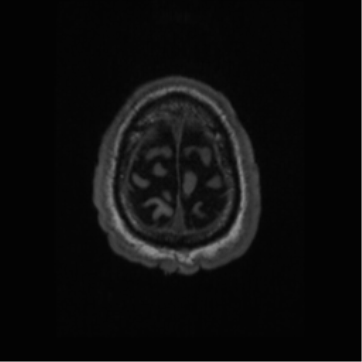 Alzheimer disease - probable (Radiopaedia 35334-36837 Axial T1 68).png