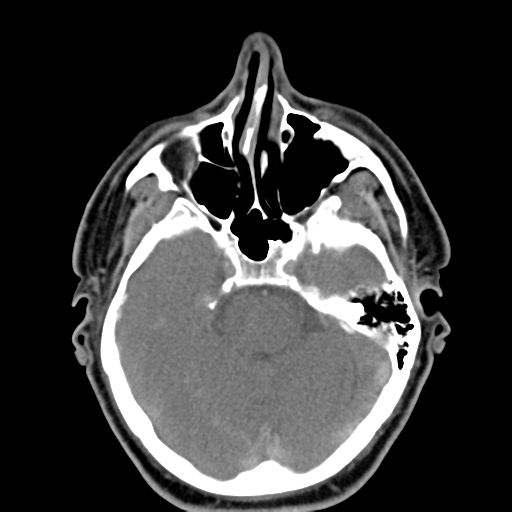 File:Ameloblastoma (Radiopaedia 38520-40623 Axial non-contrast 9).png