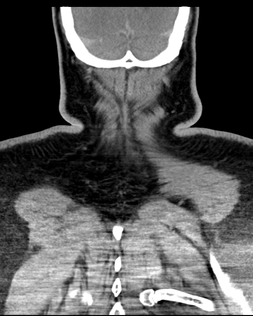 Ameloblastoma (Radiopaedia 38520-40623 Coronal non-contrast 70).png