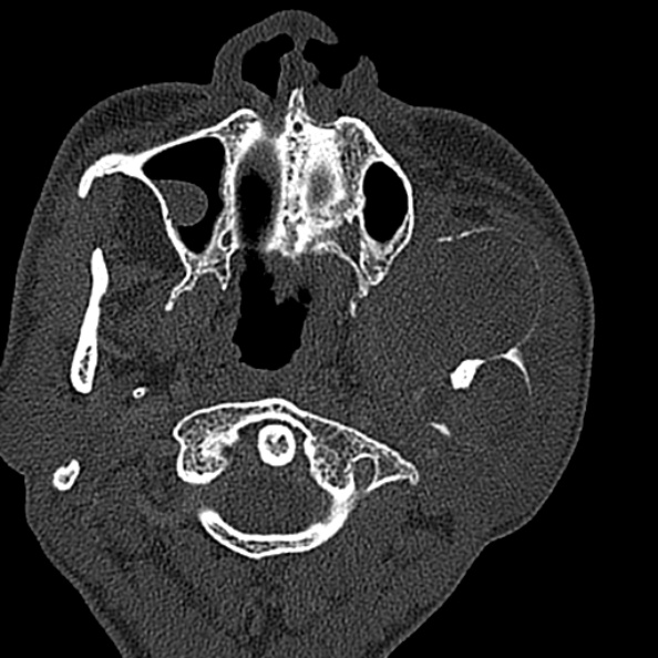 Ameloblastoma (Radiopaedia 51921-57766 Axial bone window 111).jpg