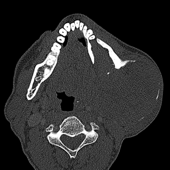 Ameloblastoma (Radiopaedia 51921-57766 Axial bone window 66).jpg