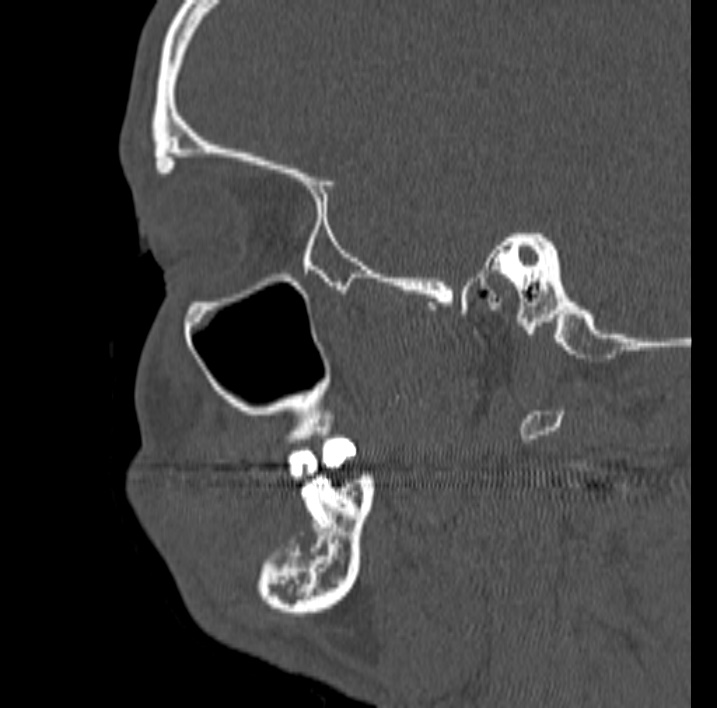 Ameloblastoma (Radiopaedia 77750-89997 Sagittal bone window 59).jpg