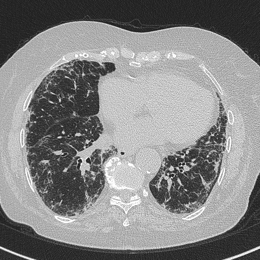 Amiodarone-induced pulmonary fibrosis (Radiopaedia 82355-96460 Axial lung window 46).jpg