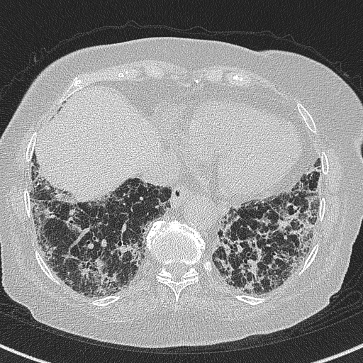 Amiodarone-induced pulmonary fibrosis (Radiopaedia 82355-96460 Axial lung window 53).jpg