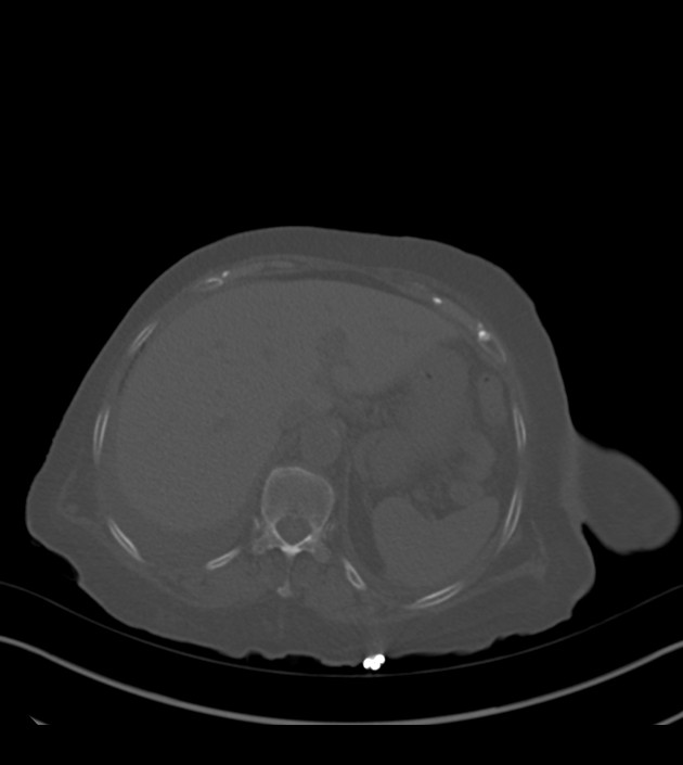 Amiodarone deposition in the liver (Radiopaedia 77587-89780 Axial bone window 76).jpg