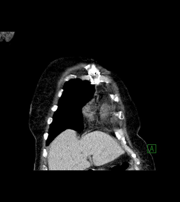 Amiodarone deposition in the liver (Radiopaedia 77587-89780 Coronal non-contrast 17).jpg