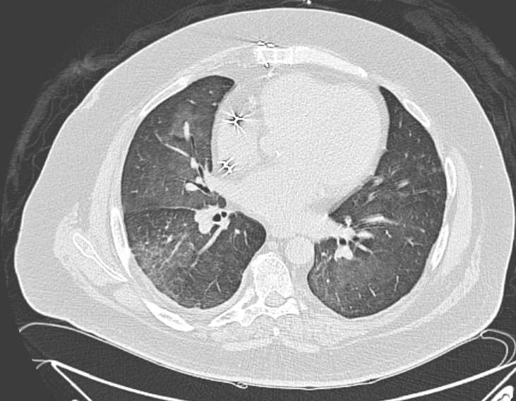 File:Amiodarone lung (Radiopaedia 62514-70769 Axial lung window 51).jpg