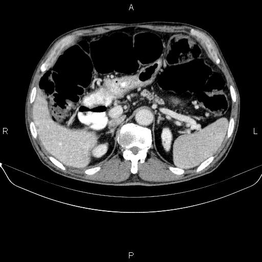 Ampullary adenocarcinoma (Radiopaedia 86093-102032 A 18).jpg