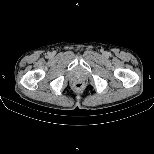 Ampullary adenocarcinoma (Radiopaedia 86093-102032 Axial C+ delayed 109).jpg