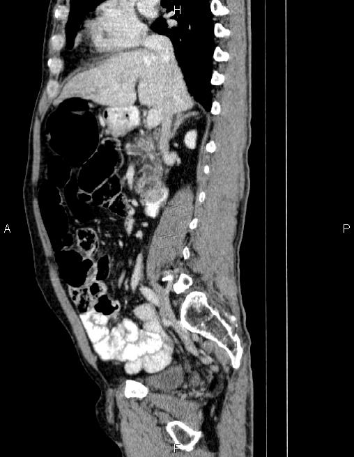 Ampullary adenocarcinoma (Radiopaedia 86093-102032 D 38).jpg