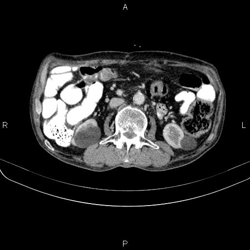 Ampullary adenocarcinoma (Radiopaedia 86093-102033 B 70).jpg