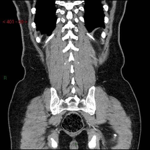 Ampullary carcinoma (Radiopaedia 56396-63056 E 79).jpg