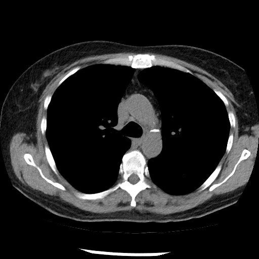 Amyloidosis - bronchial and diffuse nodular pulmonary involvement (Radiopaedia 60156-67744 Axial non-contrast 21).jpg