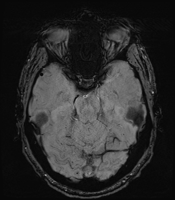 Amyotrophic lateral sclerosis (Radiopaedia 87352-103658 Axial SWI 17).jpg