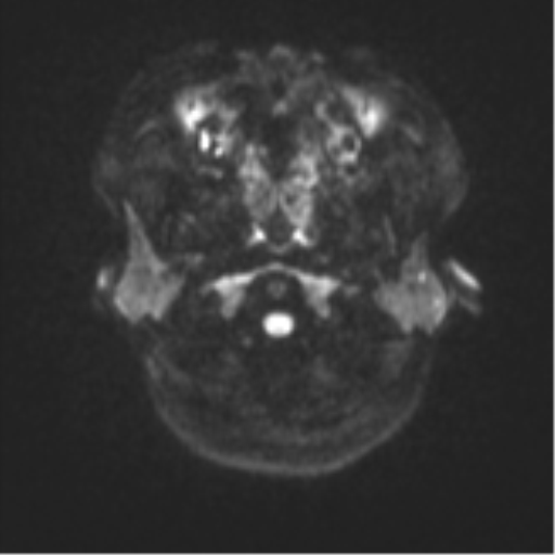 Anaplastic astroblastoma (Radiopaedia 55666-62194 Axial DWI 29).png