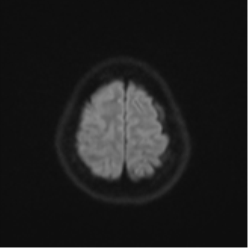 Anaplastic astroblastoma (Radiopaedia 55666-62194 Axial DWI 53).png