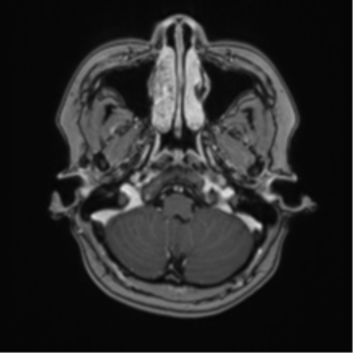 Anaplastic astroblastoma (Radiopaedia 55666-62194 Axial T1 C+ 12).png