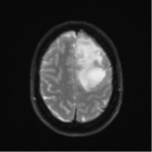Anaplastic astrocytoma (Radiopaedia 57768-64731 Axial DWI 23).png