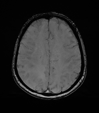 File:Anaplastic astrocytoma (Radiopaedia 86943-103160 Axial SWI 61).png