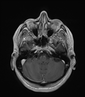 Anaplastic astrocytoma IDH wild-type (Radiopaedia 49984-55273 Axial T1 C+ 15).png