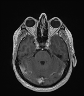 Anaplastic astrocytoma IDH wild-type (Radiopaedia 49984-55273 Axial T1 C+ 19).png